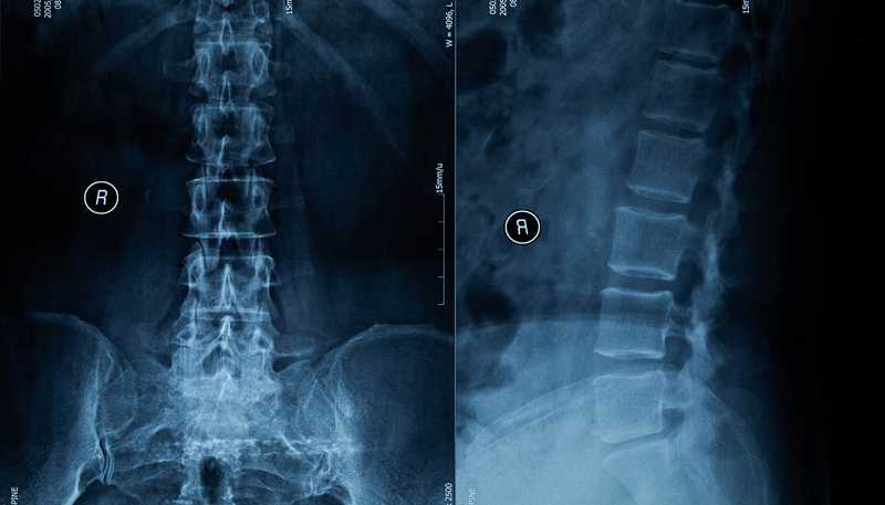 Spinal & Brain Injuries